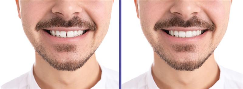 Gaped Teeth Gaped Teeth