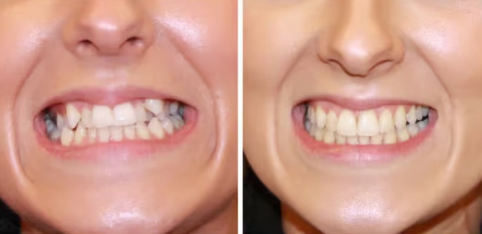 Teeth Crossbite Teeth Crossbite